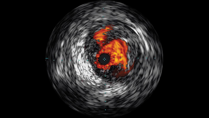 Ecograf&iacute;a intravascular