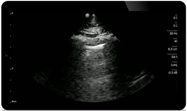 Evaluaci&oacute;n pulmonar